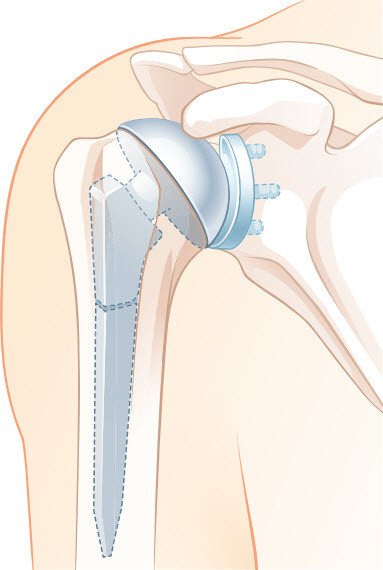 Anatomische Schulterprothese