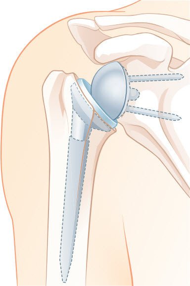 Inverse Schulterprothese