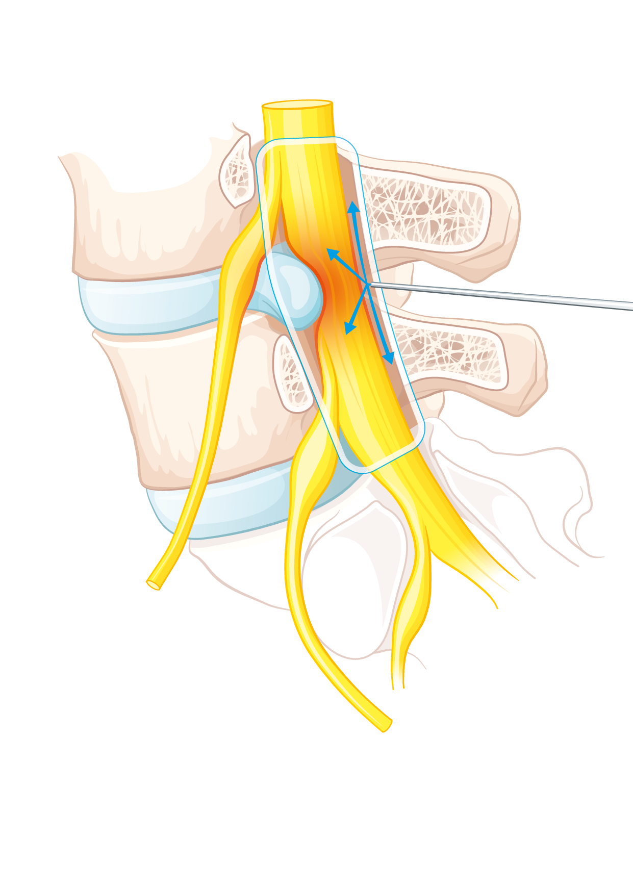 Epidurale interlaminäre Infiltration