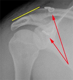 Arthroskopie AC-Gelenksluxation