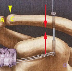 Tight-Rope System