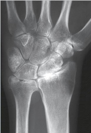 Handgelenksarthrose Schulthess Klinik
