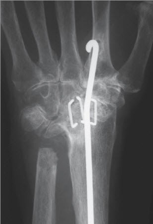 Röntgenbild Handgelenkversteifung Stab