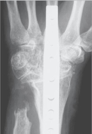 Handgelenksarthrose Schulthess Klinik