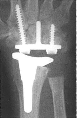 Zustand nach Implantation einer Handgelenkprothese