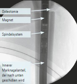 Verlängerungssystem im Nagel