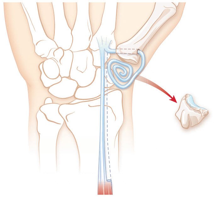OP bei fortgeschrittener Arthrose