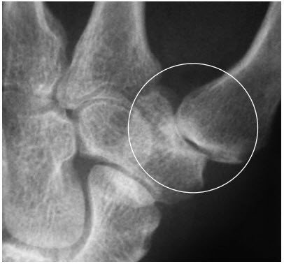 Arthrose des Daumensattelgelenks mit Gelenkspaltverschmälerung