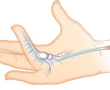 Dupuytren-Hand mit Beugekontraktur