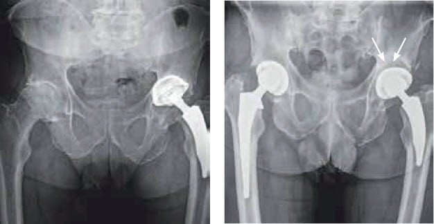 Eigenknochen Transplantation bei Hüftoperation