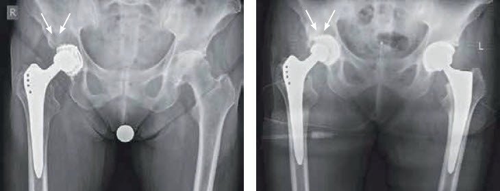 Eigenknochen Transplantation bei Hüftoperation