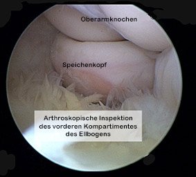 Ellbogenarthroskopie