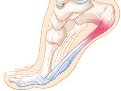 Plantaraponeurose Fersenschmerz