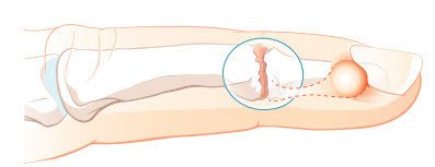 Arthrose des Fingerendgelenks