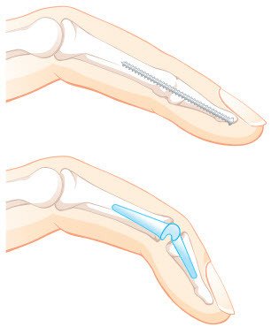 Behandlungsmöglichkeiten bei einer Arthrose des Fingerendgelenks