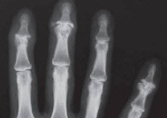 Röntgenbild Arthrosen der Endgelenke