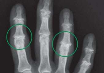 Röntgenbild Arthrose des Zeige- und Ringfingermittelgelenks