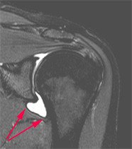 Schultersteife Frozen Shoulder Schulthess Klinik