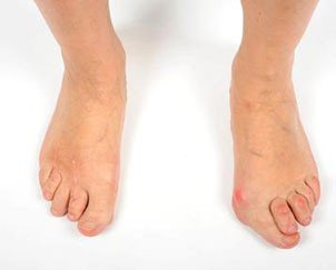 Vorfussdeformitat Bei Rheumatoider Arthritis Schulthess Klinik