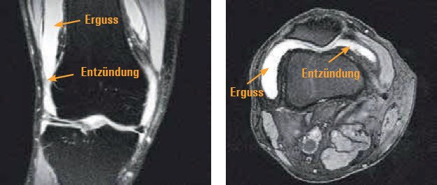 MRI Gelenkerguss