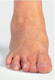 Hallux Valgus Schulthess Klinik