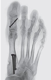 Hallux valgus Achsenkorrektur durch Versteifung des ersten Mittelfussgelenks