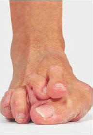 Hallux Valgus Schulthess Klinik