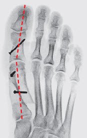 Hallux Valgus Schulthess Klinik