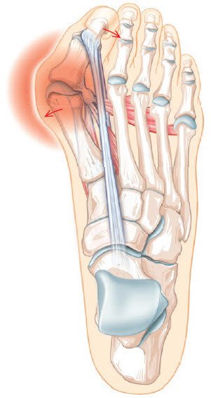 Hallux Valgus