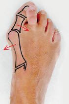 Hallux Valgus Schulthess Klinik