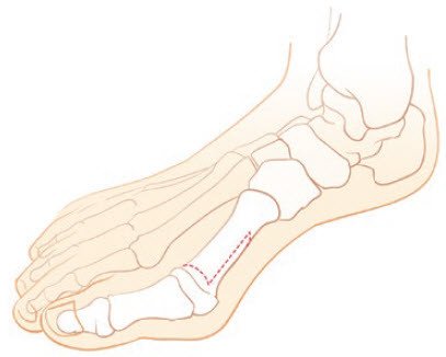 «Scarf»-Knochenschnitt Hallux Valgus