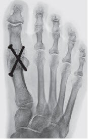 Hallux valgus Versteifung des Grosszehengrundgelenks