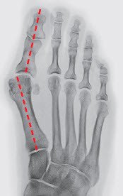 Hallux valgus Röntgenbild vor der Operation