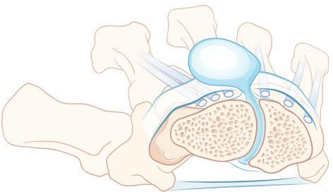 Ganglion mit Ursprung zwischen Kahn- und Mondbein