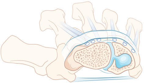 Ganglion mit Wachstum in den Knochen
