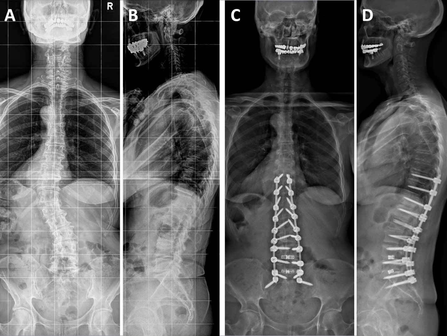 Skoliose Wirbelsaulenverkrummung Schulthess Klinik