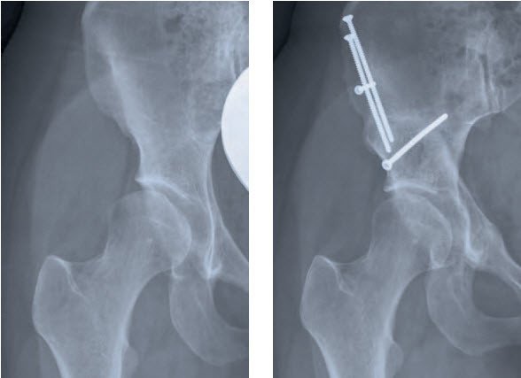 Periacetabuläre Osteotomie (PAO) zur Behandlung einer Hüftdysplasie