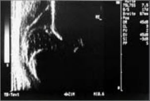 Sonographiebild einer Hüftluxation