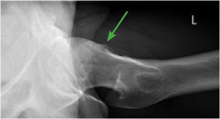 CAM-Impingement (FAI)