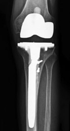 Revisionsoperation Knieprothese