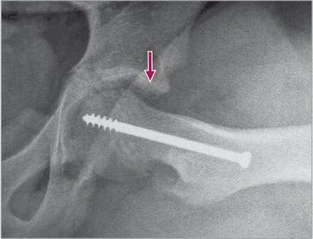 In-situ-Fixation