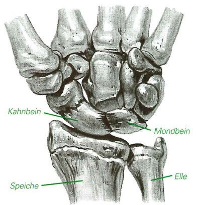 Kahnbeinbruch