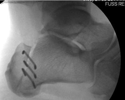 Röntgen Fuss seitlich postoperativ