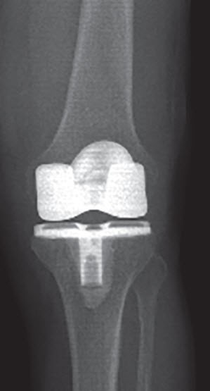 Lange künstliches arbeitsunfähig wie knie Wie lange