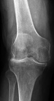 Schlittenprothese knie wie lange krank
