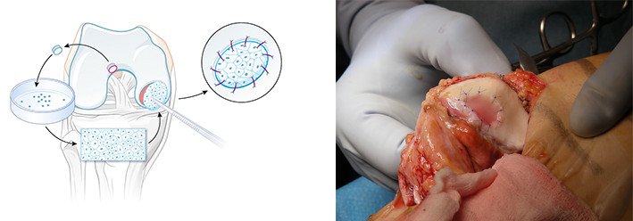 Knorpelzelltransplantation