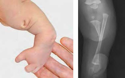 Fehlbildungen Bei Neugeborenen An Beinen Und Fussen Schulthess Klinik