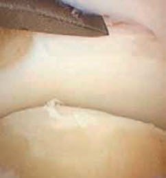 Lange Beugesehne des Grosszehs und unteres Sprunggelenk