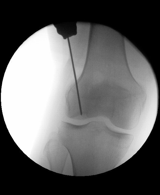 Röntgenbild retrograde Anbohrung eines Osteochondrosis dissecans