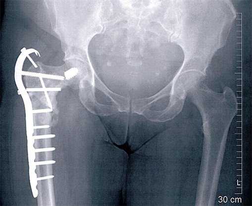 Pseudoarthrose nach Femurfraktur